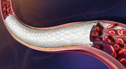 BD-New-AGILITY-trial-data-presented-at-VIVA-2026New AGILITY trial data presented at VIVA 2026 reinforce BD’s commitment to advancing peripheral vascular care. Nine-month results from the iliac cohort showed strong safety and effectiveness outcomes for the Revello™ Vascular Covered Stent, including 97.2% primary patency and 98.3% freedom from clinically driven target lesion revascularization. Together, these findings expand the growing body of evidence supporting innovative treatment options for patients with PAD.