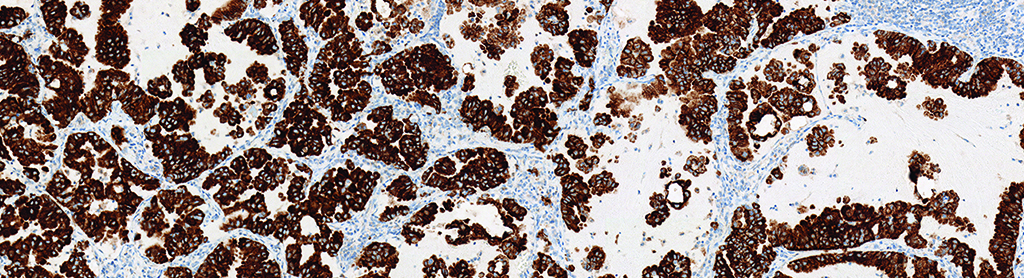 Positive case of lung tissue stained for ALK with VENTANA ALK (D5F3) CDx Assay (Source: Ventana Medical Systems. Inc. a member of the Roche Group)