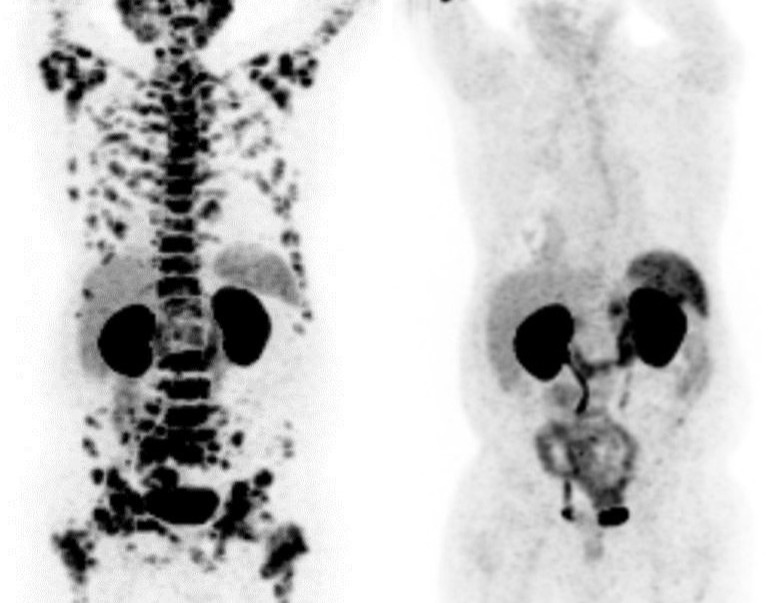 Medical scan of human body showing before and after Ac-225Advanced-stage cancer in remission after 3 doses of Actinium-225 therapy. Research originally published in the December 2016 issue of the Journal of Nuclear Medicine. (Image Credit: Serva)