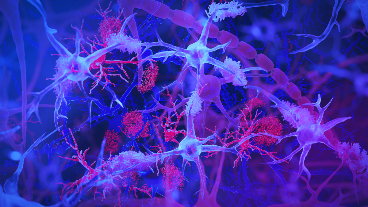 The brain's immune cells, or microglia (light blue/purple), are shown interacting with amyloid plaques (red) — harmful protein clumps linked to Alzheimer’s disease. The illustration highlights the microglia’s role in monitoring brain health and clearing debris. Illustration by Jason Drees/Arizona