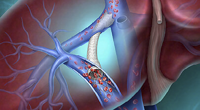 BD® Liverty™ TIPS Stent Graft